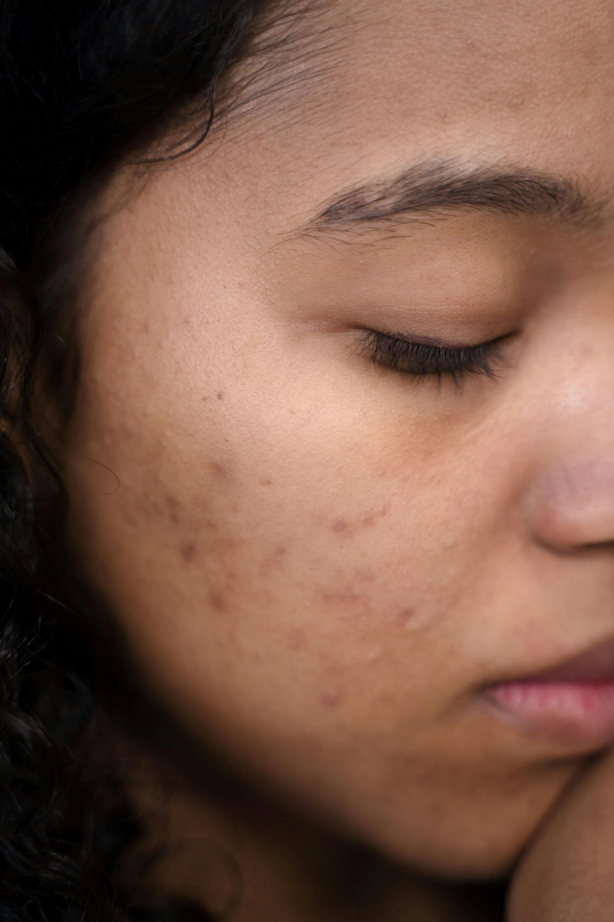 Understanding and Managing Kid’s Acne: A Guide for Parents