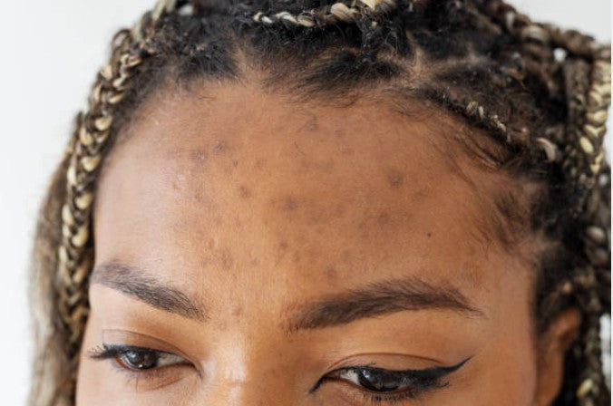 June is Acne Awareness Month: Help Your Teen Fight Breakouts Naturally with Our Turmeric Bar